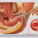 intrauterine-insemination-150x150